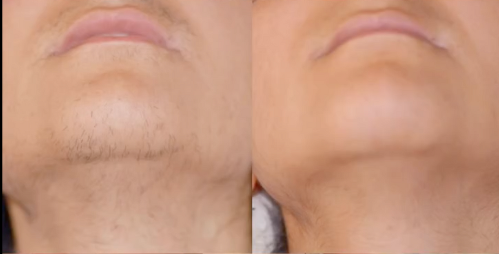 ANTI-HAIR OIL • permanent disappearance of hair!