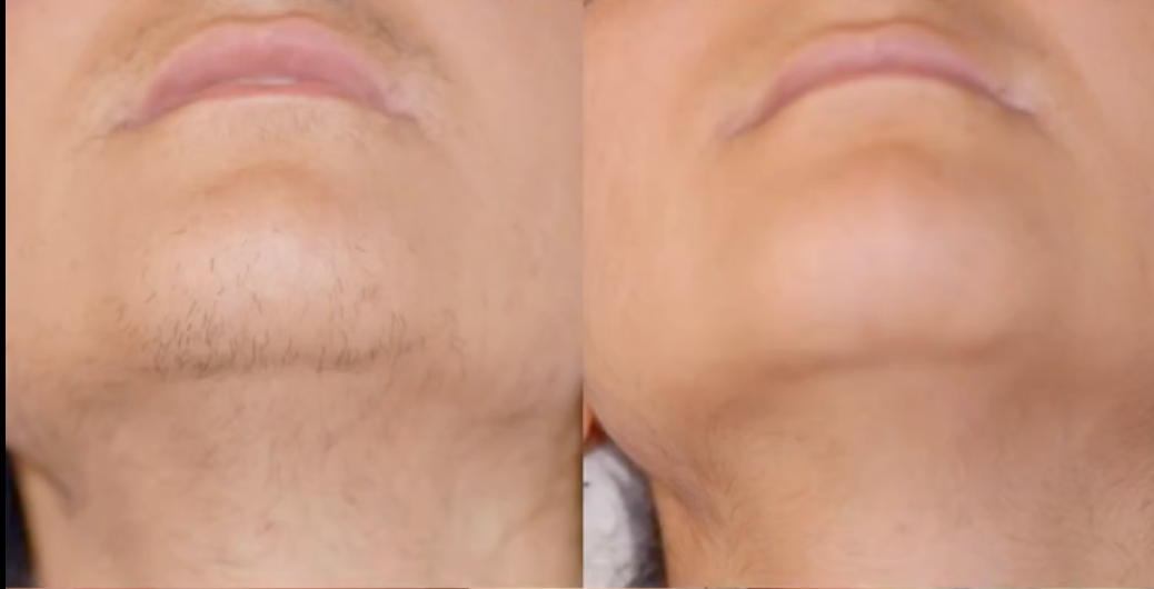 ANTI-HAIR OIL • permanent disappearance of hair!