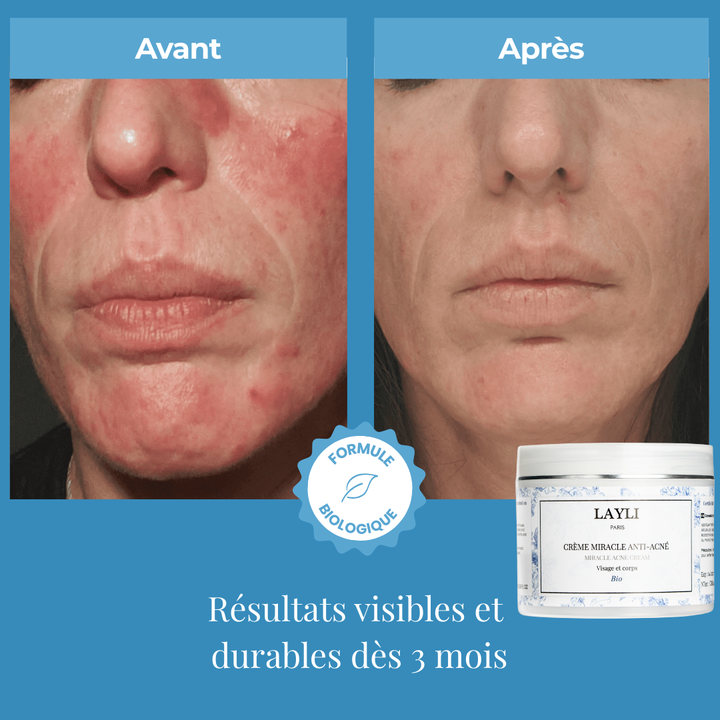 CRÈME MIRACLE ANTI-ACNÉ BIO • à la bave d'escargot, nombreux résultats