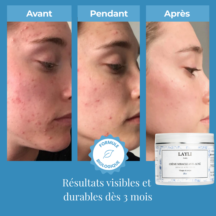 CRÈME MIRACLE ANTI-ACNÉ BIO • à la bave d'escargot, nombreux résultats