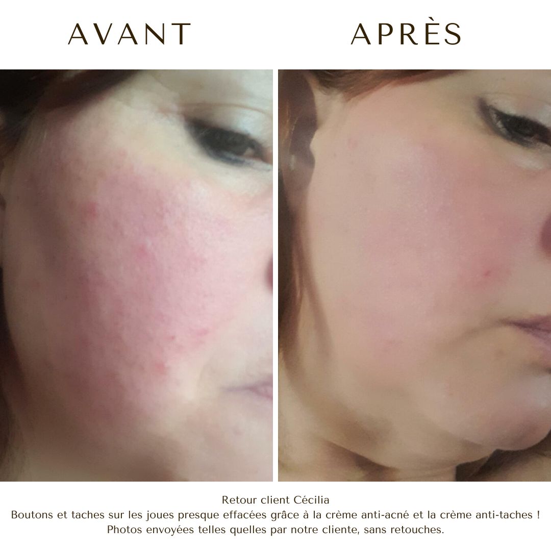 crème acné layli layli avis crème anti acné bio crème layli huile poils anti poils Image